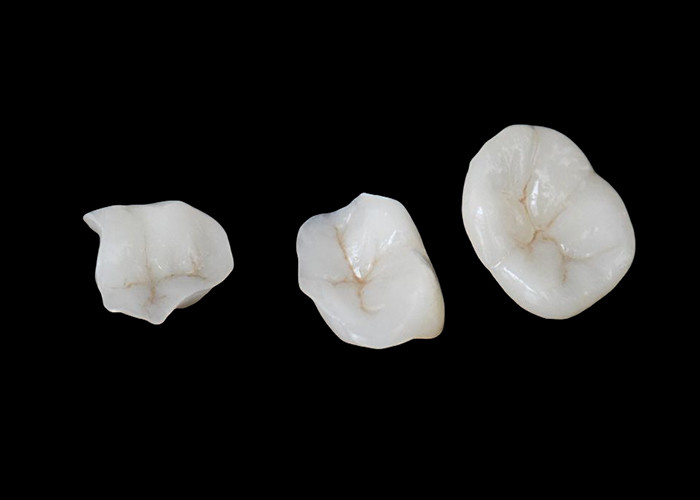 Inlays e onlays cerâmicos biocompativeis concebidos para uma durabilidade confortável e integração perfeita com os dentes naturais