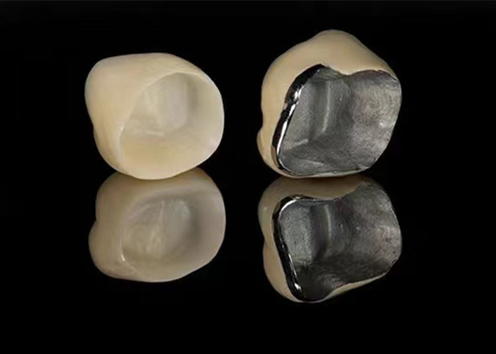 Porcelana de aparência natural fundida com coroa de metal para restaurar dentes danificados
