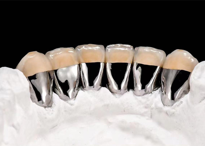 Porcelana de aparência natural fundida com coroa de metal para restaurar dentes danificados