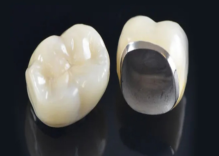 Porcelana de aparência natural fundida com coroa de metal para restaurar dentes danificados