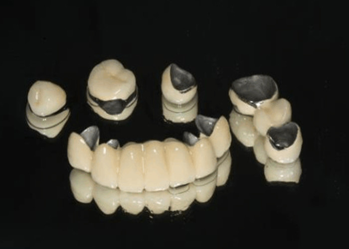 Porcelana fundida a metal PFM resistência ao desgaste dental da coroa para odontologia restaurativa