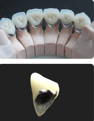 Porcelana fundida a metal PFM resistência ao desgaste dental da coroa para odontologia restaurativa