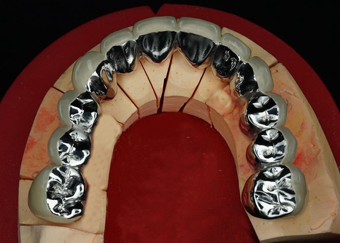 Porcelana de restauração altamente durável fundida com coroa de metal para um sorriso de aparência natural