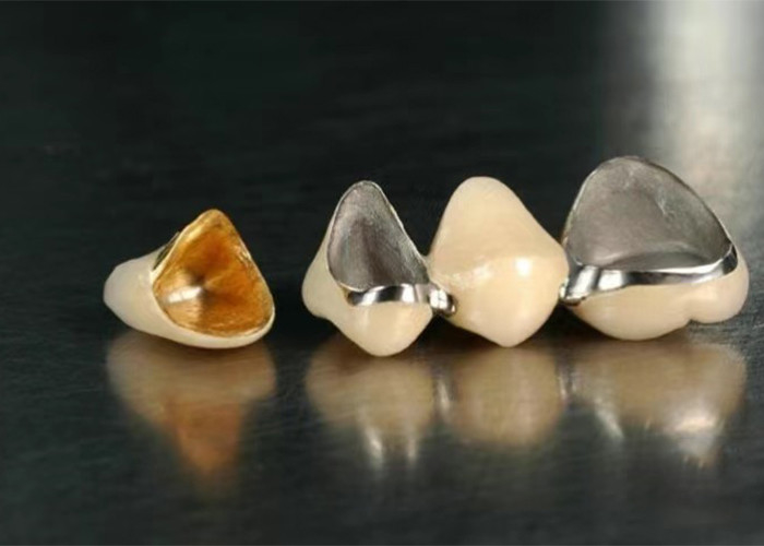 Porcelana de restauração altamente durável fundida com coroa de metal para um sorriso de aparência natural