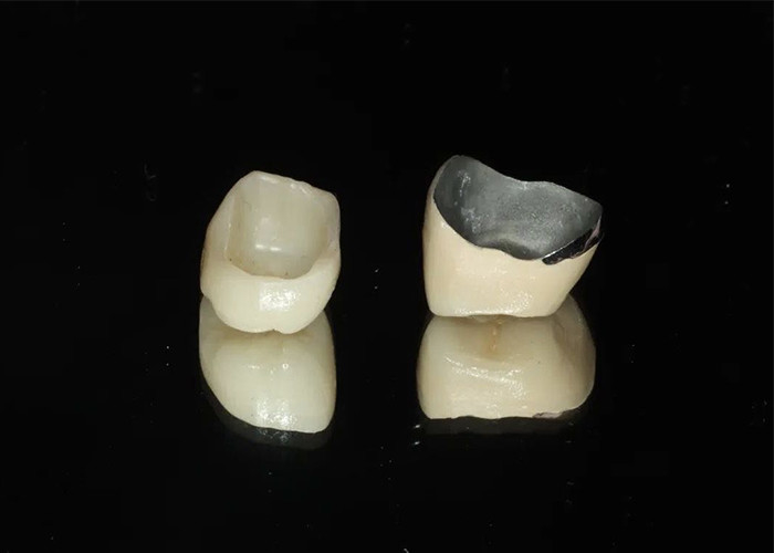Porcelana de restauração altamente durável fundida com coroa de metal para um sorriso de aparência natural