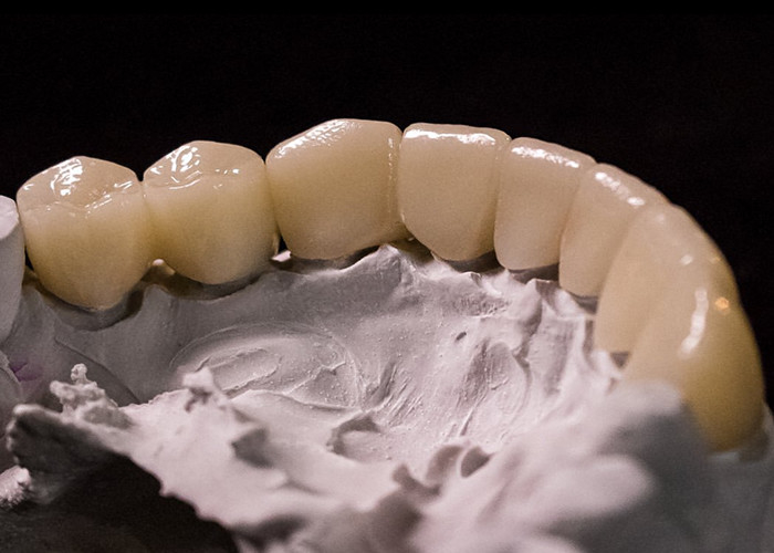 Porcelana fundida a coroas metálicas - Tecnologia avançada para restaurar o sorriso duradouro
