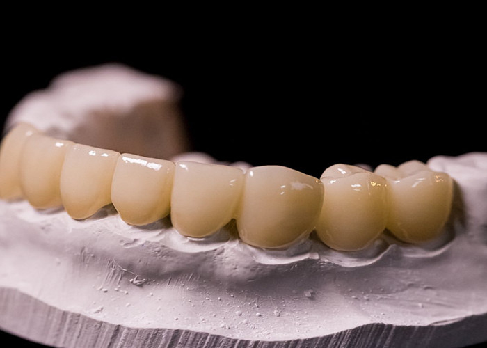 Porcelana fundida a coroas metálicas - Tecnologia avançada para restaurar o sorriso duradouro