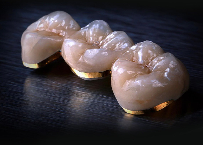 Porcelana fundida a coroas metálicas - Tecnologia avançada para restaurar o sorriso duradouro