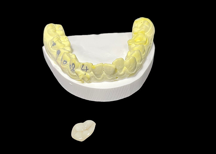 Inlays e Onlays de cerâmica dentária feitos sob medida para soluções restauradoras e reparação de dentes danificados