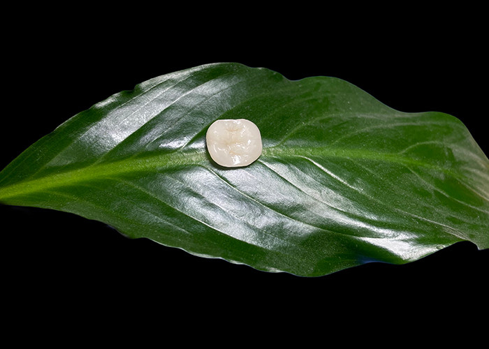 Inlays e Onlays de cerâmica dentária feitos sob medida para soluções restauradoras e reparação de dentes danificados