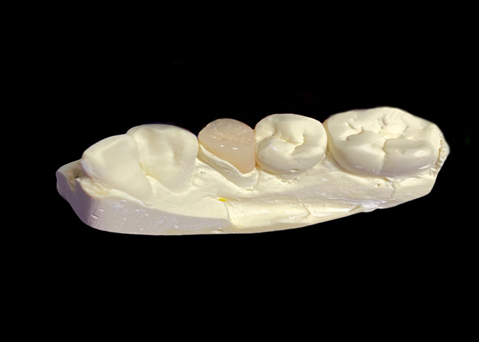 Inlays e Onlays de cerâmica dentária feitos sob medida para soluções restauradoras e reparação de dentes danificados