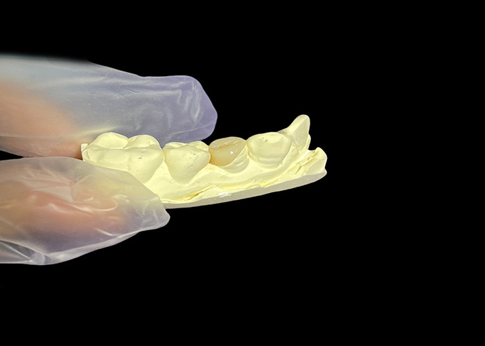 Inlay dentário de cerâmica Onlay para reparação eficaz de dentes com soluções de porcelana duradouras e estéticas para restauração duradoura