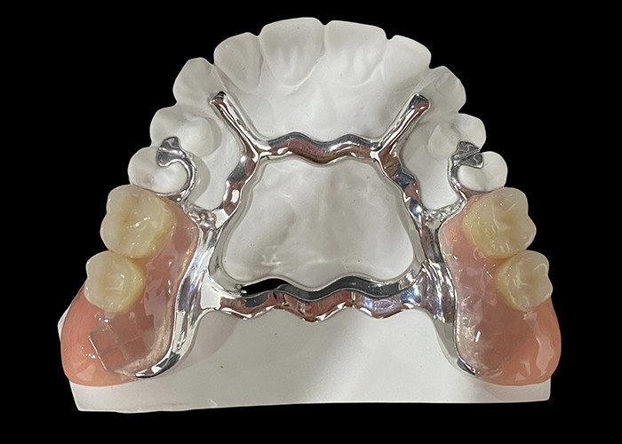 Dentadura parcial removível de base metálica e resina acrílica para um ajuste seguro e aparência natural