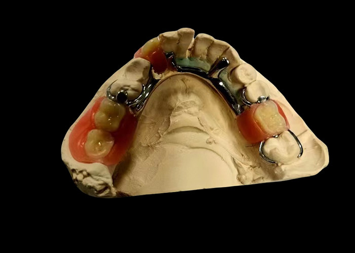 Dentadura parcial removível de base metálica e resina acrílica para um ajuste seguro e aparência natural