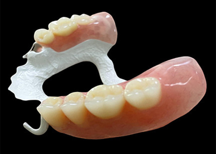 Dentadura parcial removível personalizada com estrutura de polímero de alto desempenho (HPP) para conforto e durabilidade superiores