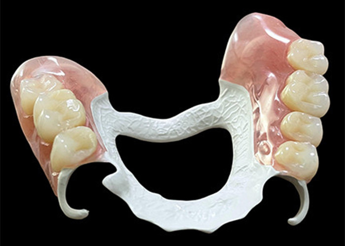 Dentadura parcial removível personalizada com estrutura de polímero de alto desempenho (HPP) para conforto e durabilidade superiores