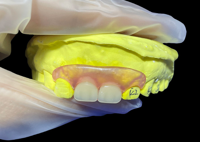 Adaptado, seguro, invisível, flexível, substituto de dentadura parital para mastigar e falar confortavelmente.