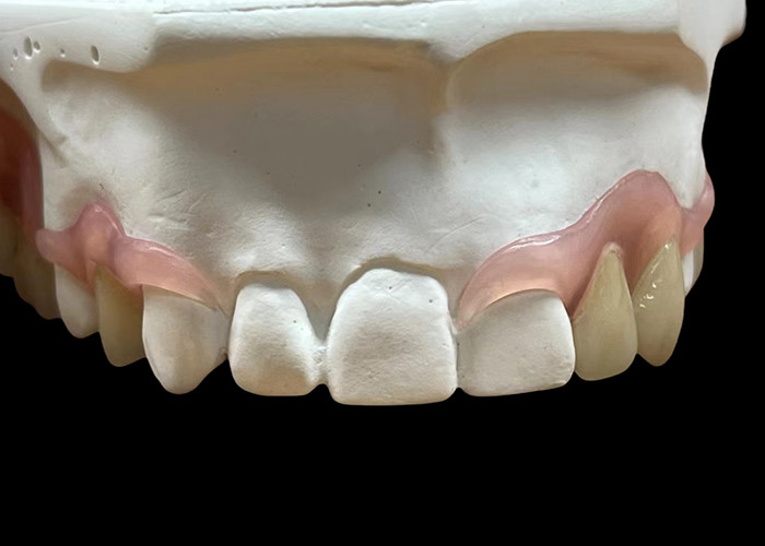 Adaptado, seguro, invisível, flexível, substituto de dentadura parital para mastigar e falar confortavelmente.