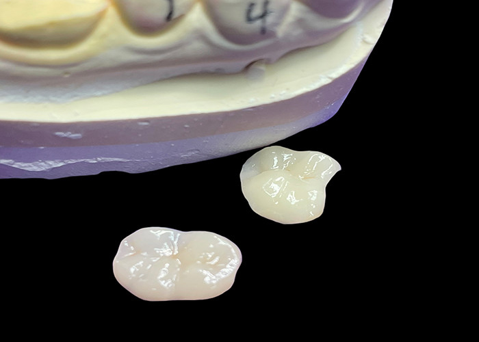 IPS e.max Inlays e Onlays cerâmicos para restauração molar Estética natural e durabilidade superior para resultados duradouros