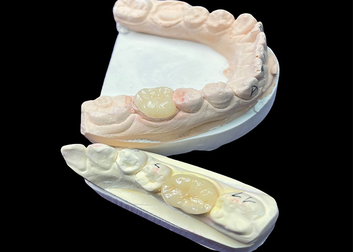 IPS e.max Inlays e Onlays cerâmicos para restauração molar Estética natural e durabilidade superior para resultados duradouros