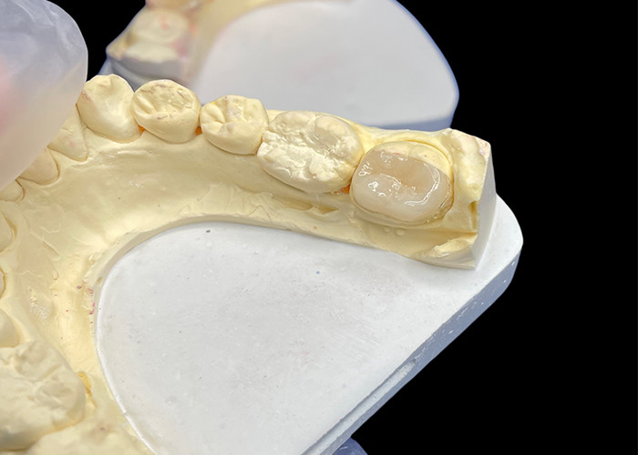 IPS e.max Inlays e Onlays cerâmicos para restauração molar Estética natural e durabilidade superior para resultados duradouros