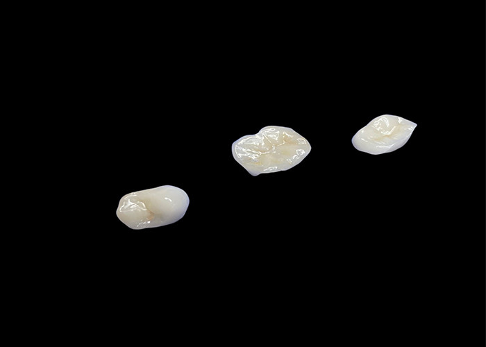 Inlays e onlays cerâmicos biocompativeis concebidos para uma durabilidade confortável e integração perfeita com os dentes naturais