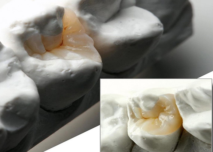 Inlays e Onlays de cerâmica de aparência natural para restauração dental precisa do nosso laboratório dental especializado