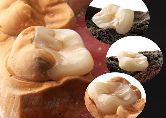 Inlays e Onlays de cerâmica de aparência natural para restauração dental precisa do nosso laboratório dental especializado
