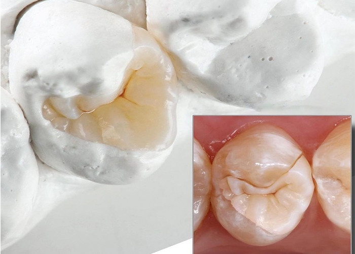 Inlays e Onlays de cerâmica de aparência natural para restauração dental precisa do nosso laboratório dental especializado