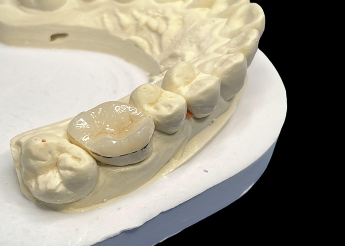 Inlays de porcelana hipoalergênica Inlays para reparação de dentes Cor natural e fácil manutenção