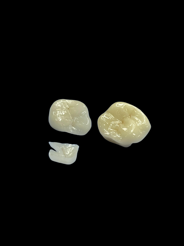 Inlays de porcelana hipoalergênica Inlays para reparação de dentes Cor natural e fácil manutenção