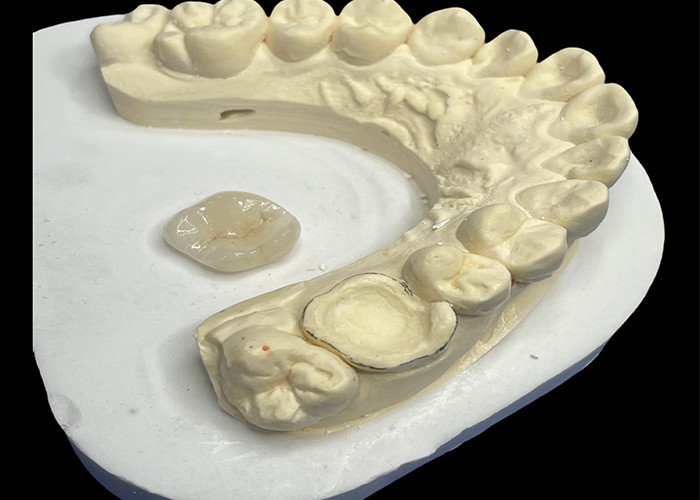 Inlay dentário de cerâmica Onlay para reparação eficaz de dentes com soluções de porcelana duradouras e estéticas para restauração duradoura