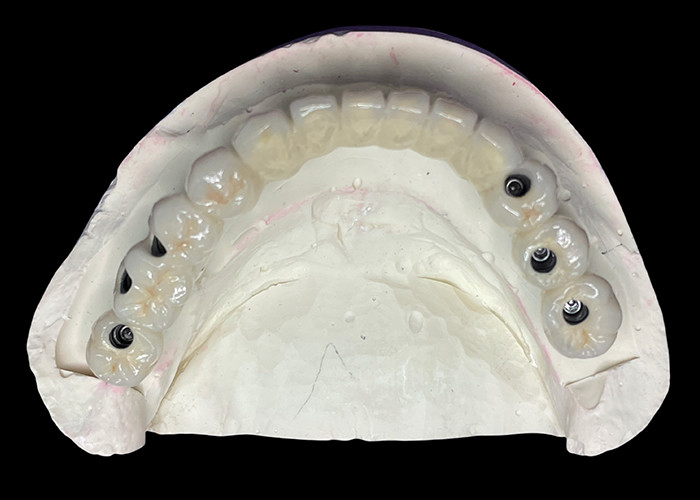 O implante dentário com uma base de titânio é coberto com uma bela ponte de coroa de cerâmica para criar uma restauração perfeita.