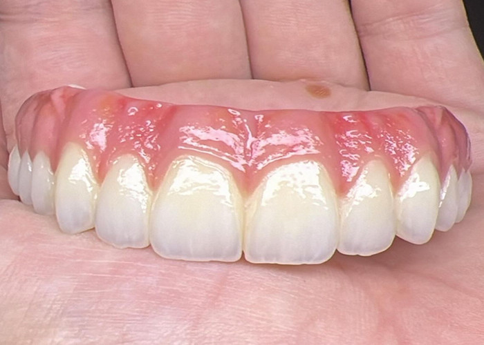 Saúde Oral Implante Dental Dentes dentários apoiados Ponte Superfície polida Suporte Dentes dentários completos