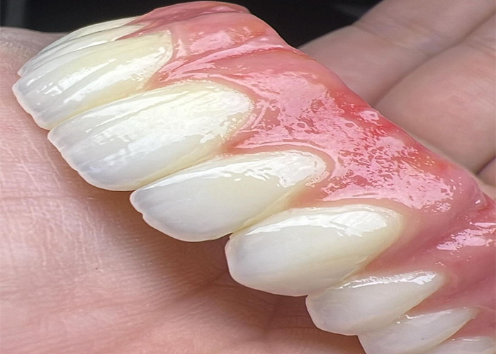 Saúde Oral Implante Dental Dentes dentários apoiados Ponte Superfície polida Suporte Dentes dentários completos
