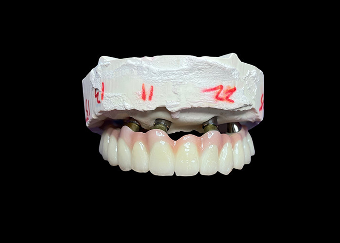 Dentes de arco completo fixos com implantes dentários para solução permanente, estável e de aparência natural para os dentes ausentes