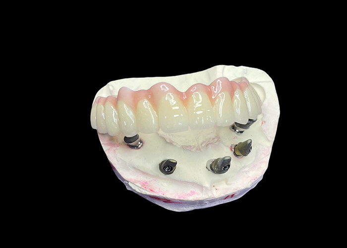 Dentes de arco completo fixos com implantes dentários para solução permanente, estável e de aparência natural para os dentes ausentes