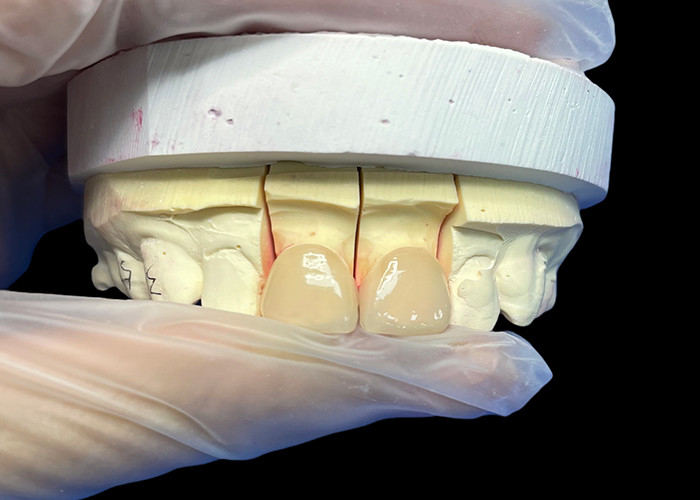 Precision Strength EMAX Porcelain Veneer incisor para restaurações estéticas de aparência natural
