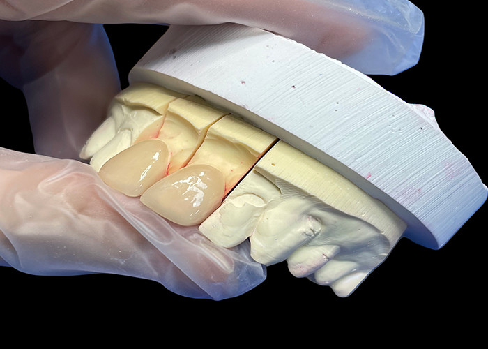 Precision Strength EMAX Porcelain Veneer incisor para restaurações estéticas de aparência natural