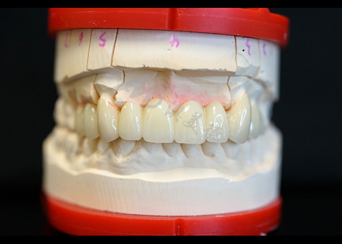 Força Estética natural Coroa de zircônio sólido Perfeito para dentes únicos ou múltiplos