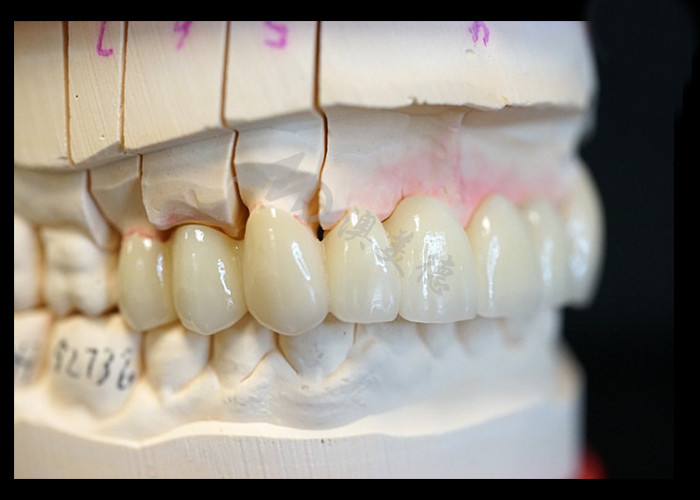 Força Estética natural Coroa de zircônio sólido Perfeito para dentes únicos ou múltiplos