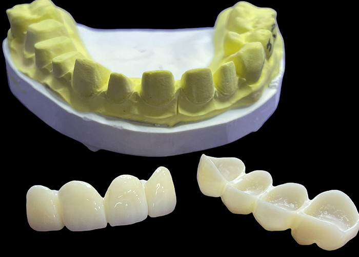 Coroas e pontes de porcelana dental resistentes a manchas em tons clássicos Vita para estética natural