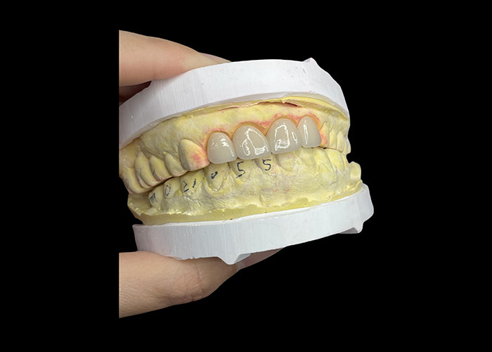 Coroas e pontes de porcelana dental resistentes a manchas em tons clássicos Vita para estética natural