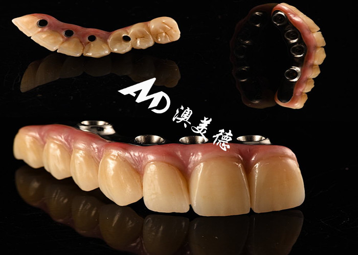 Implante Dental de Aparência Natural Ponte da Coroa Fixada com um pilar de Titânio para Cirurgia de Dentes Faltantes
