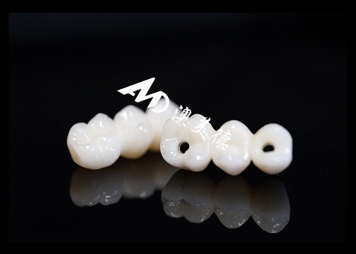 Implante Dental de Aparência Natural Ponte da Coroa Fixada com um pilar de Titânio para Cirurgia de Dentes Faltantes