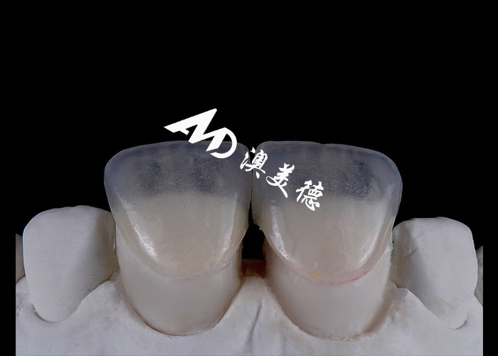 Transforme o seu sorriso com o IPS emax Pressa Veneers de porcelana Força Estética e durabilidade combinadas