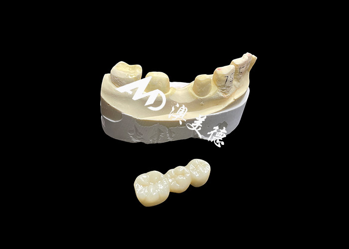 Coroa dentária de zircônio estética de alta dureza com translucidez e resistência à ruptura do laboratório dentário da China