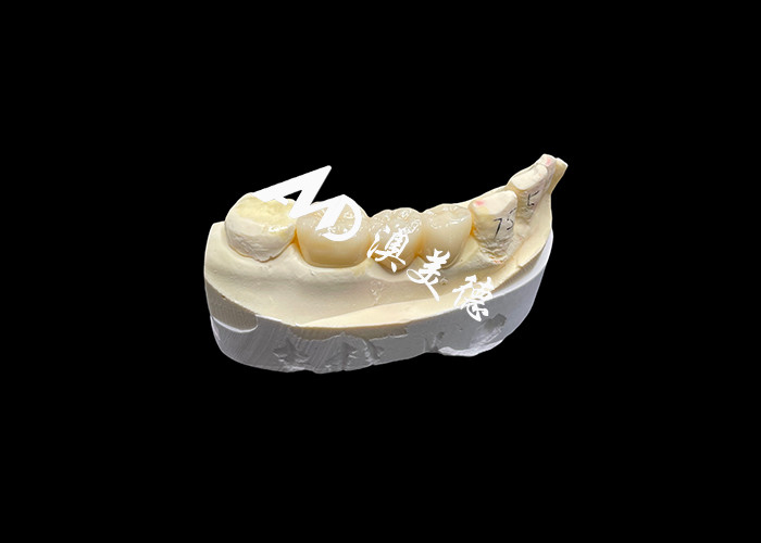 Coroa dentária de zircônio estética de alta dureza com translucidez e resistência à ruptura do laboratório dentário da China
