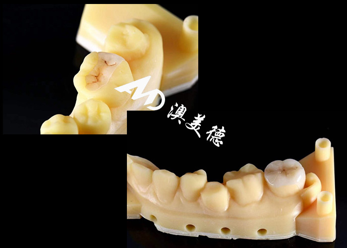 Inlays cerâmicos de precisão e onlays para reparação de dentes com cor natural material hipoalergênico e adequado sem costura para conforto superior e durabilidade