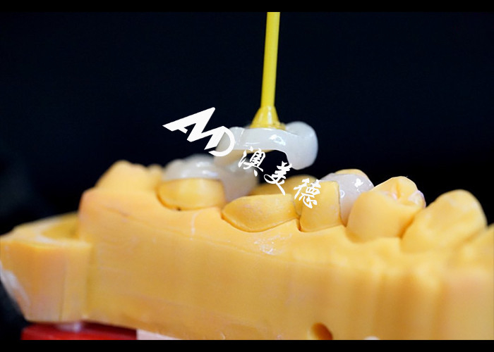 Inlays cerâmicos de precisão e onlays para reparação de dentes com cor natural material hipoalergênico e adequado sem costura para conforto superior e durabilidade